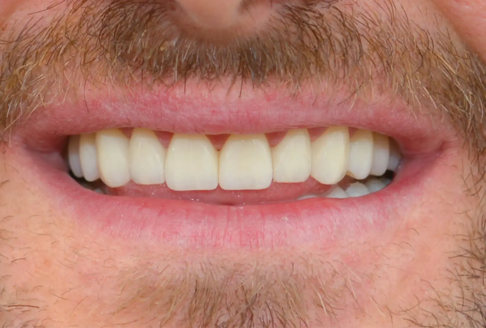 Correzione estetica dei denti:  corone in piena forma di ceramica  (sopra e sotto)​​ - dopo