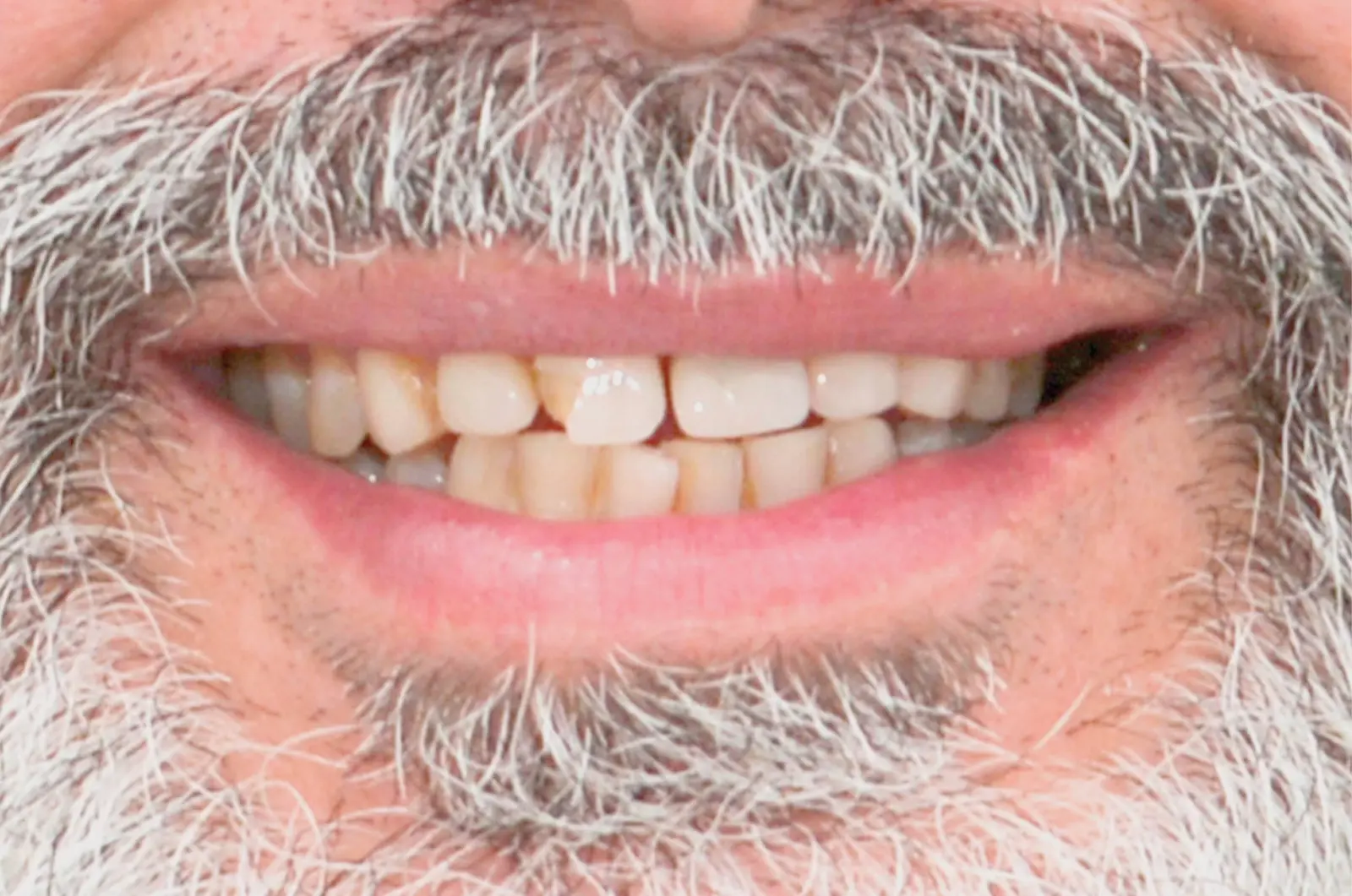 Correzione estetica dei denti: corone in piena forma di zirconio (sopra e sotto)​ - prima