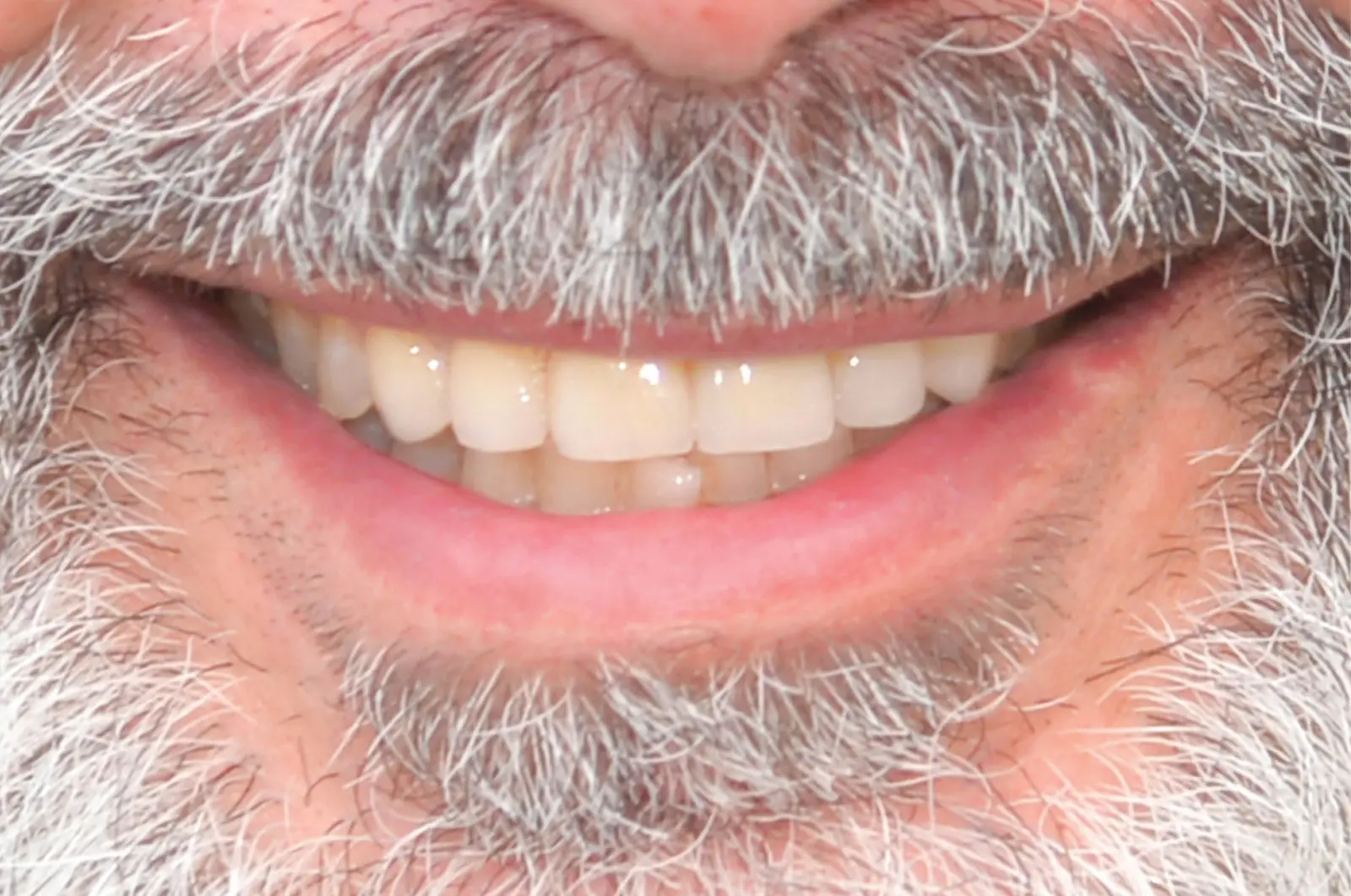 Correzione estetica dei denti: corone in piena forma di zirconio (sopra e sotto)​ - dopo