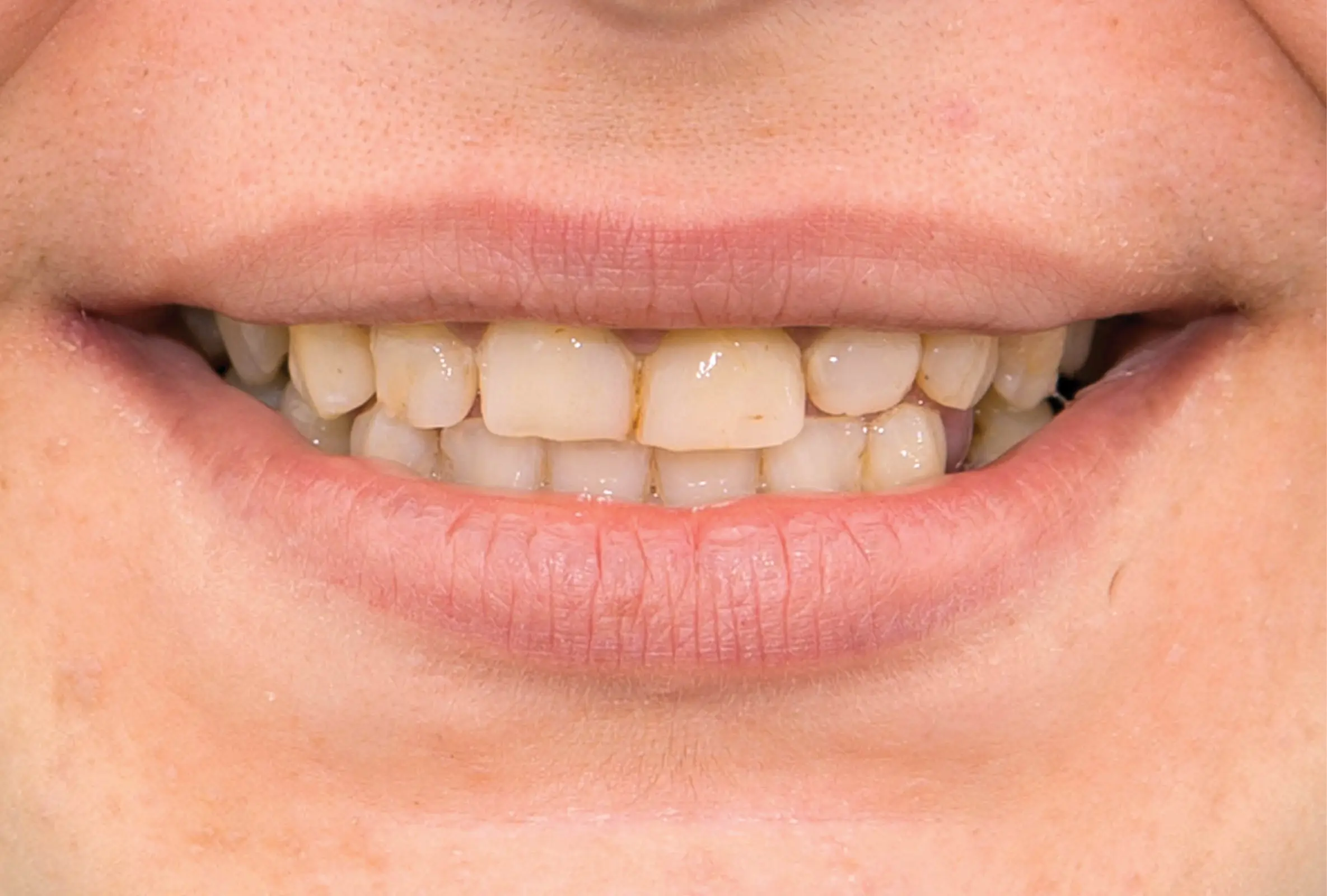 Correzione estetica dei denti:  corone in piena forma di zirconio  (sopra e sotto) - prima​
