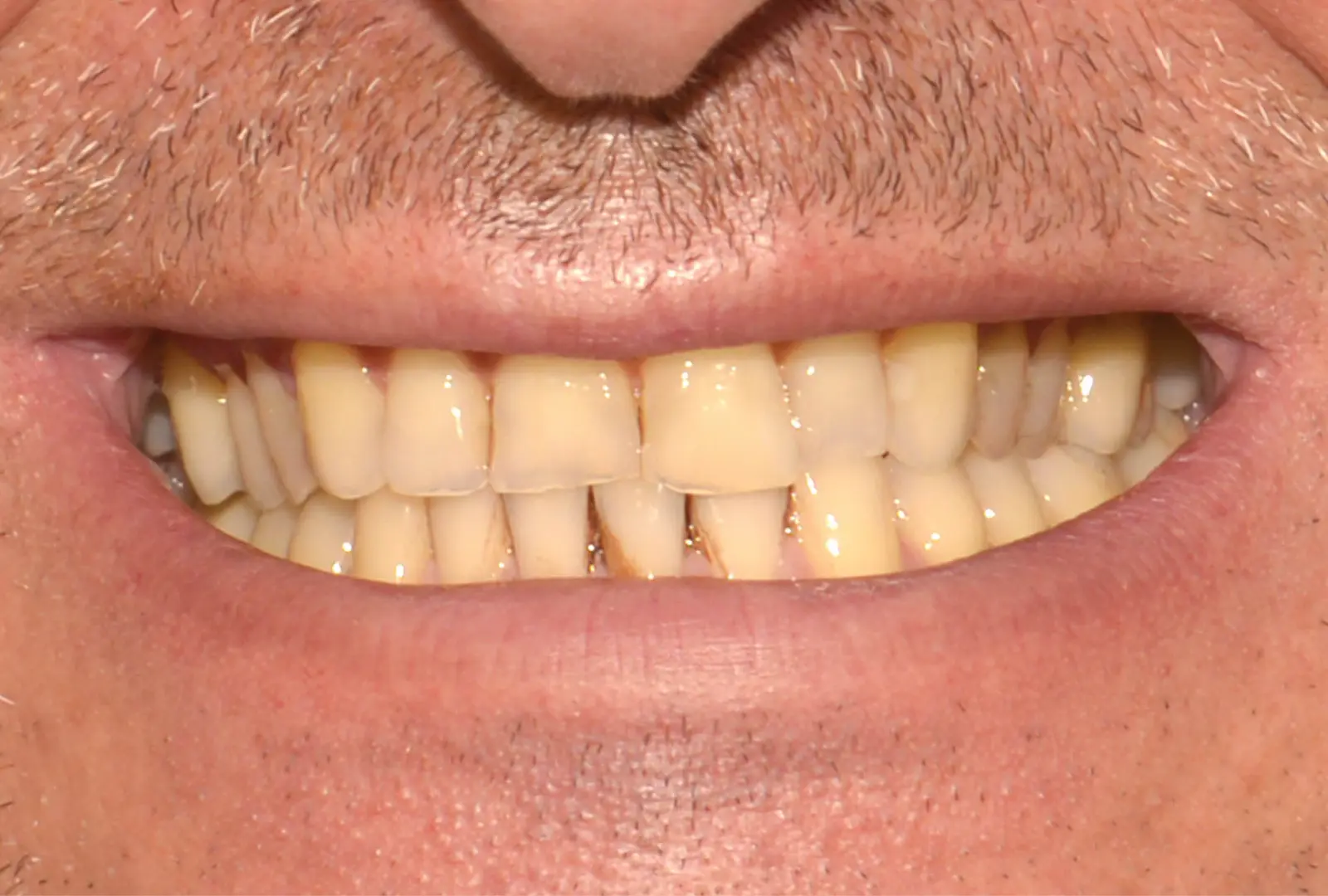 Correzione estetica dei denti:  corone in piena forma di zirconio  (sopra e sotto)​ - prima​