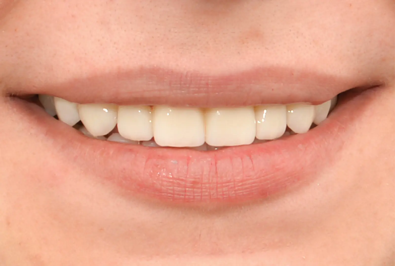 Correzione estetica dei denti:  corone in piena forma di zirconio  (sopra e sotto) - dopo