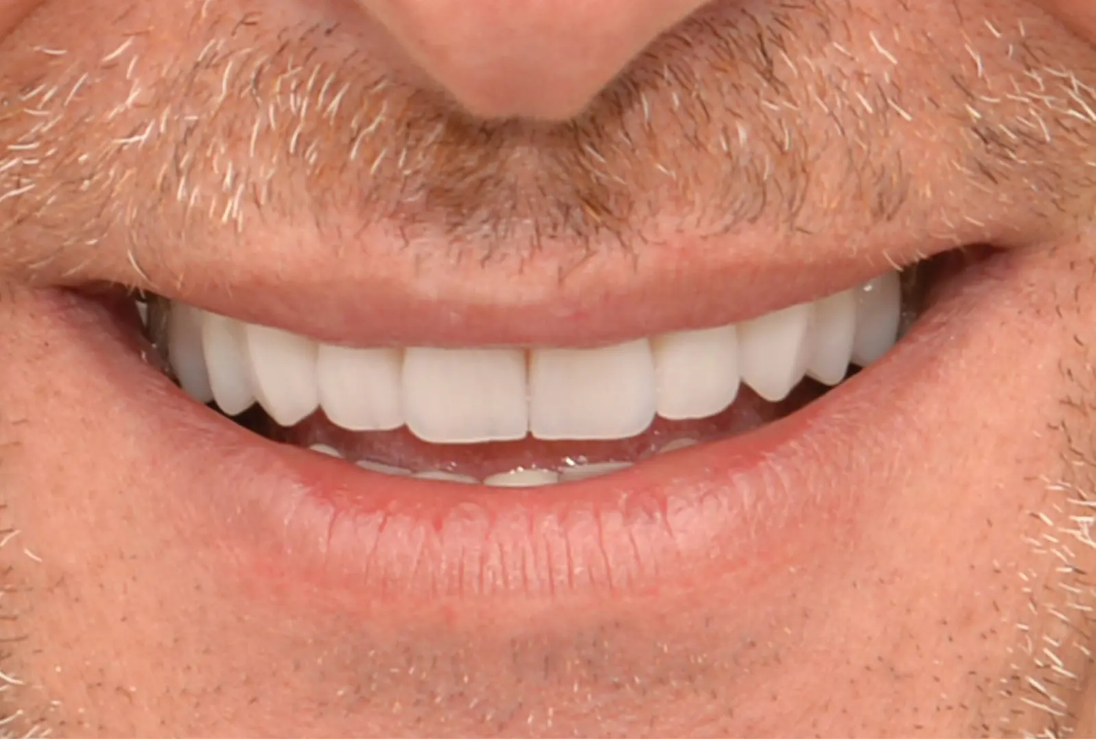 Correzione estetica dei denti:  corone in piena forma di zirconio  (sopra e sotto)​ - dopo