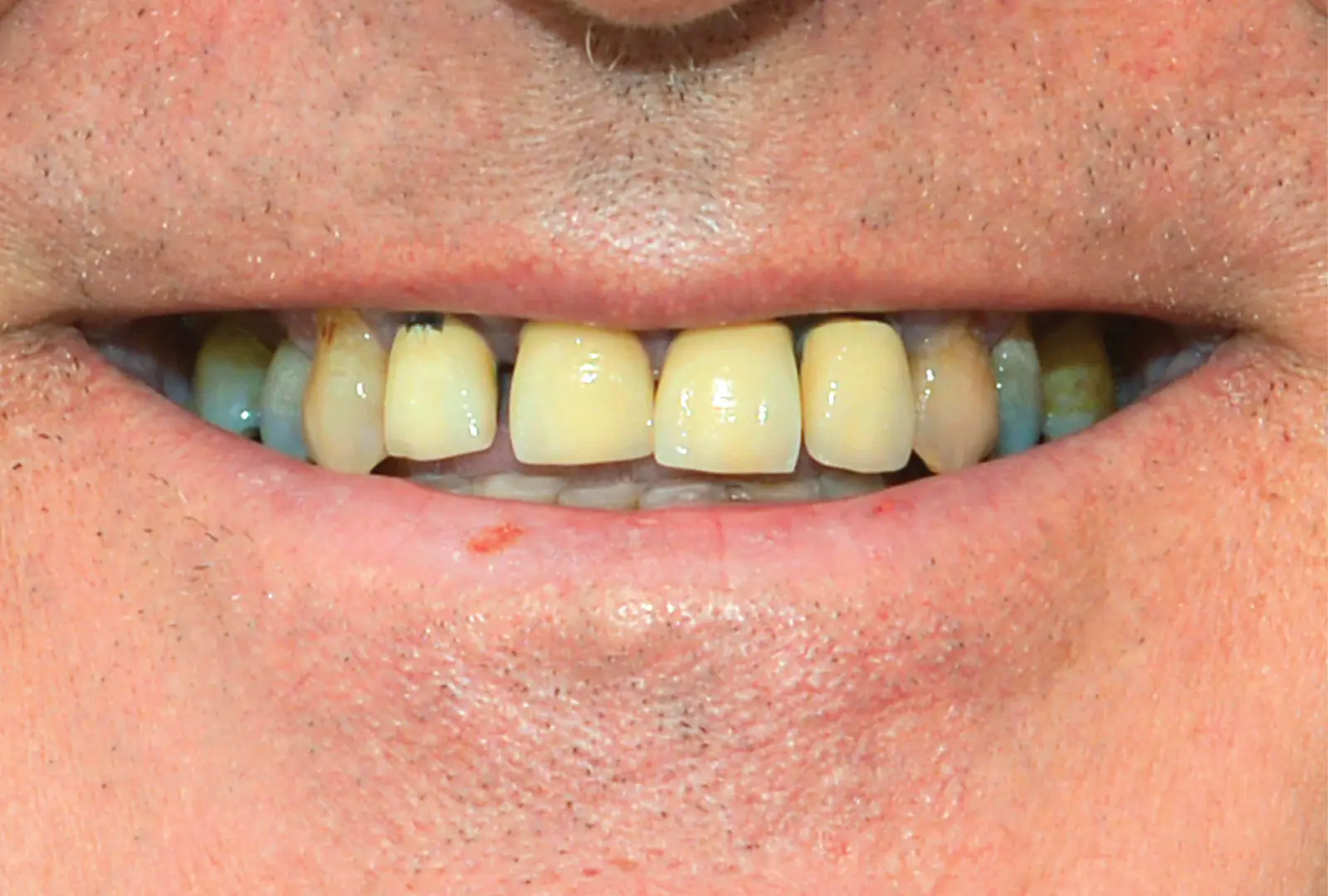 Correzione estetica e funzionale:  ponte in ceramica con la base in legura  (sopra e sotto)​​ - prima​