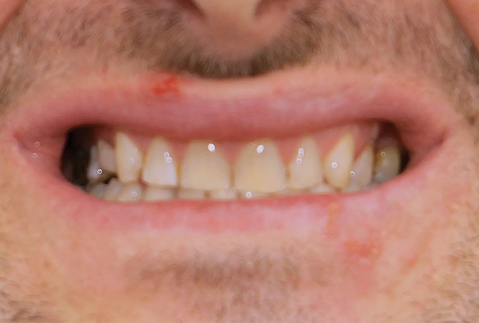 Correzione estetica dei denti:  corone in piena forma di ceramica  (sopra e sotto)​​​ - prima​