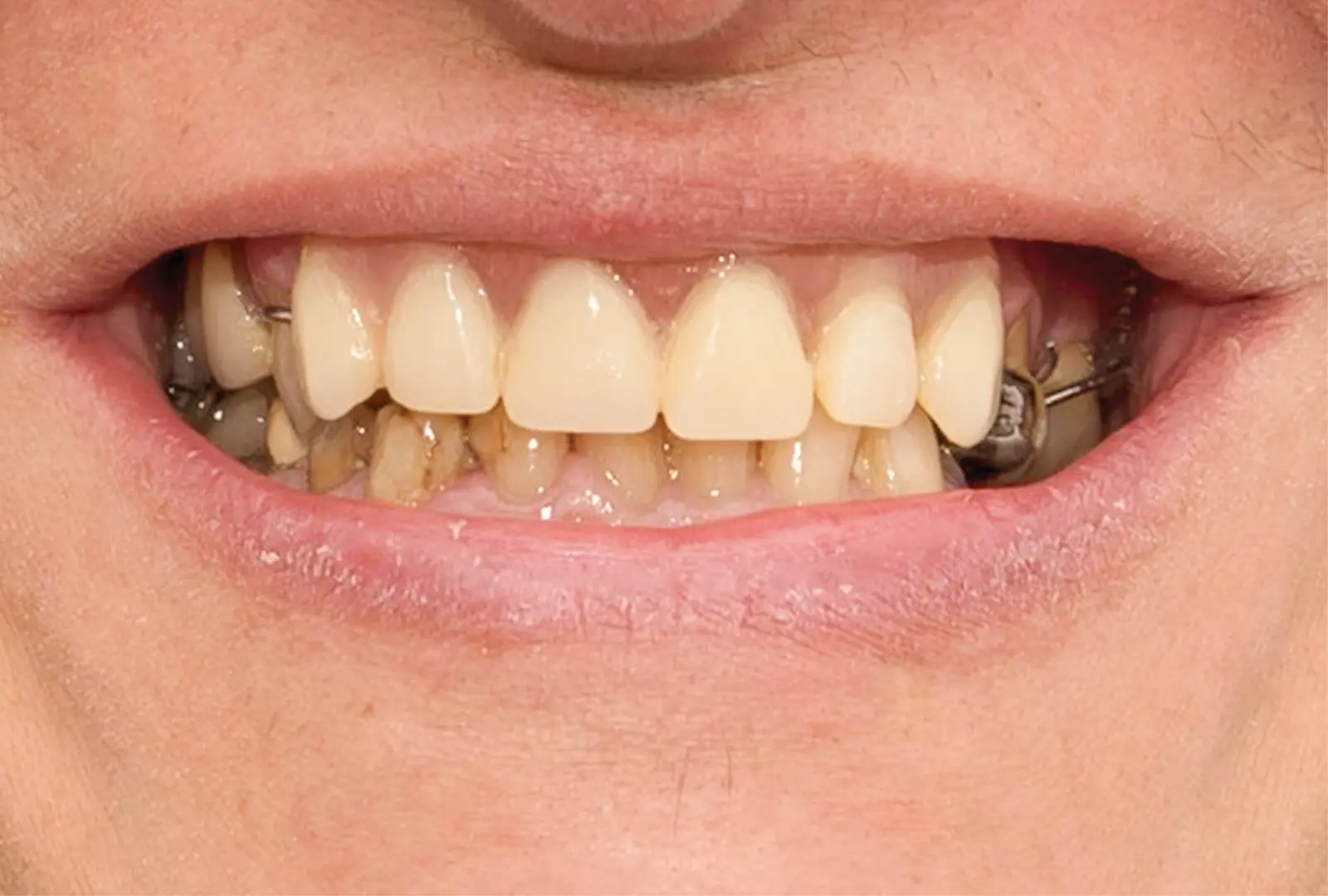 Correzione funzionale ed estetica:  protesi su corone telescopiche (sopra)  e corone in piena forma di zirconio (sotto)​ - prima​