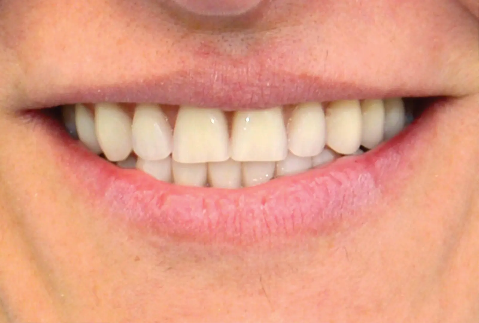 Correzione funzionale ed estetica:  protesi su corone telescopiche (sopra)  e corone in piena forma di zirconio (sotto)​- dopo