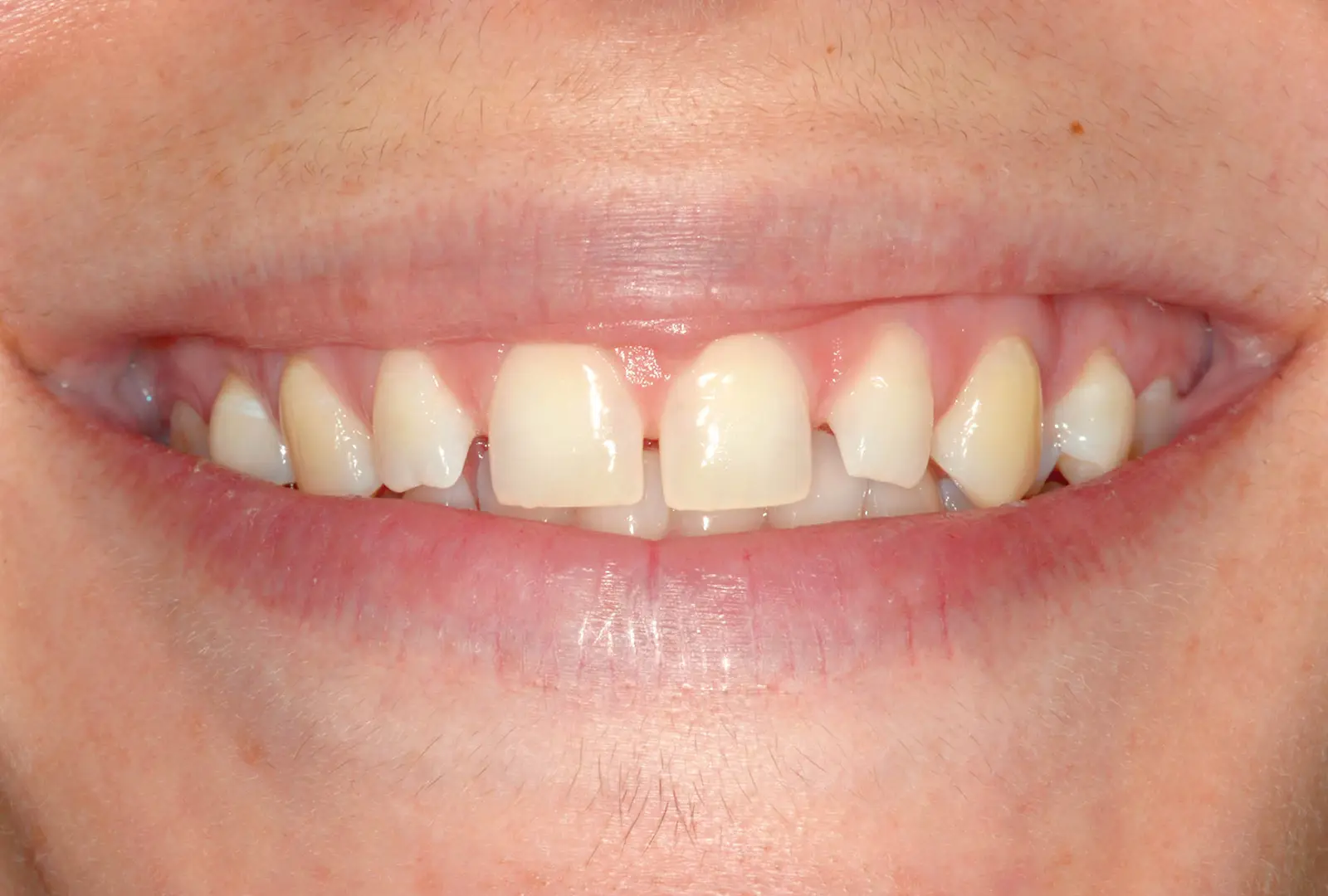 Correzione estetica dei denti: facette  (sopra) - prima​