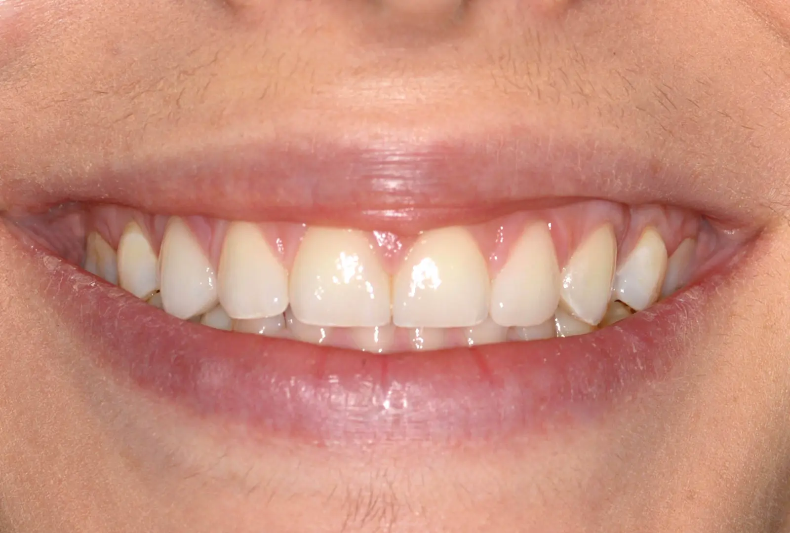 Correzione estetica dei denti: facette (sopra) ​- dopo