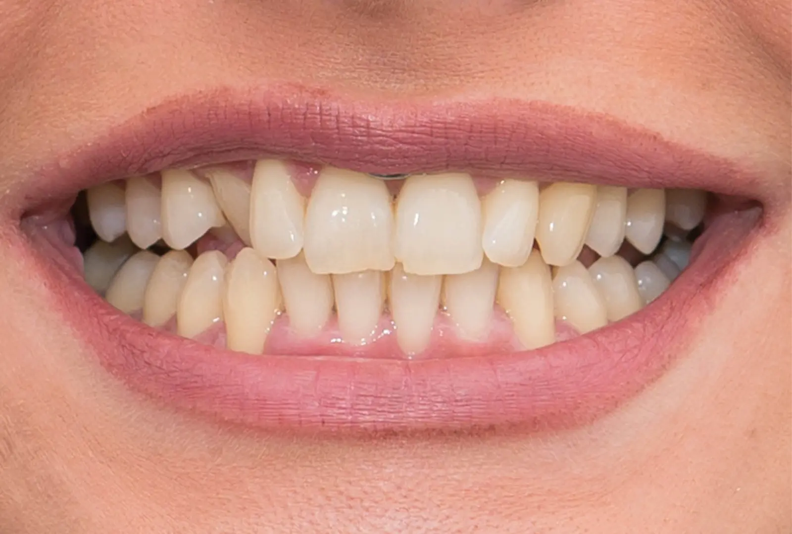 Correzione estetica del dente:  corona in piena forma di ceramica  (sopra)​ - prima​