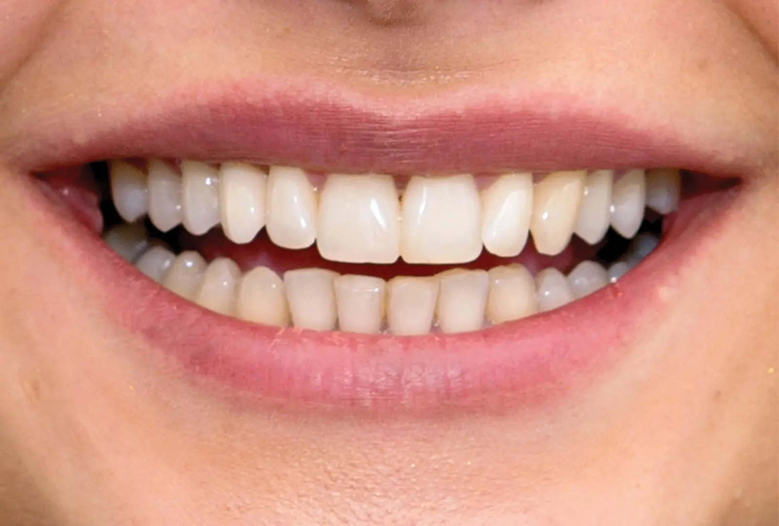 Correzione estetica del dente:  corona in piena forma di ceramica  (sopra)​ ​- dopo