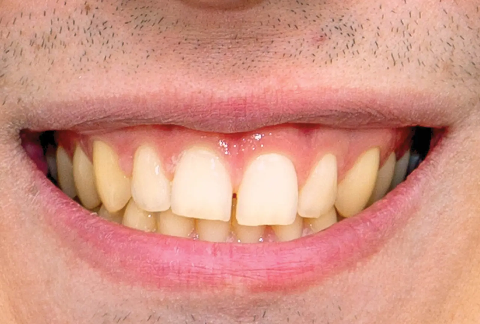 Correzione estetica dei denti:  faccette in composito (sopra)​​ - prima​