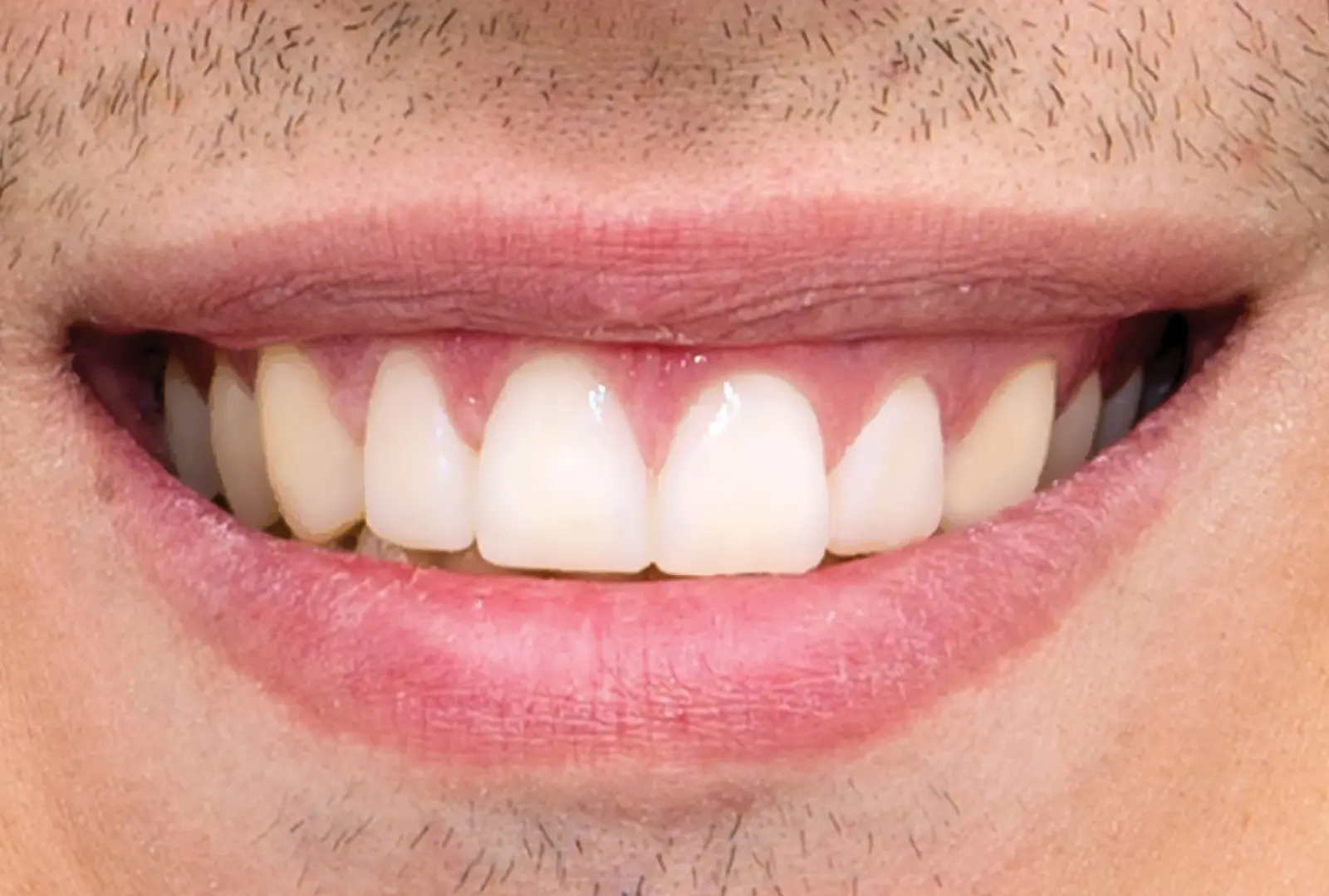 Correzione estetica dei denti:  faccette in composito (sopra)​ ​- dopo