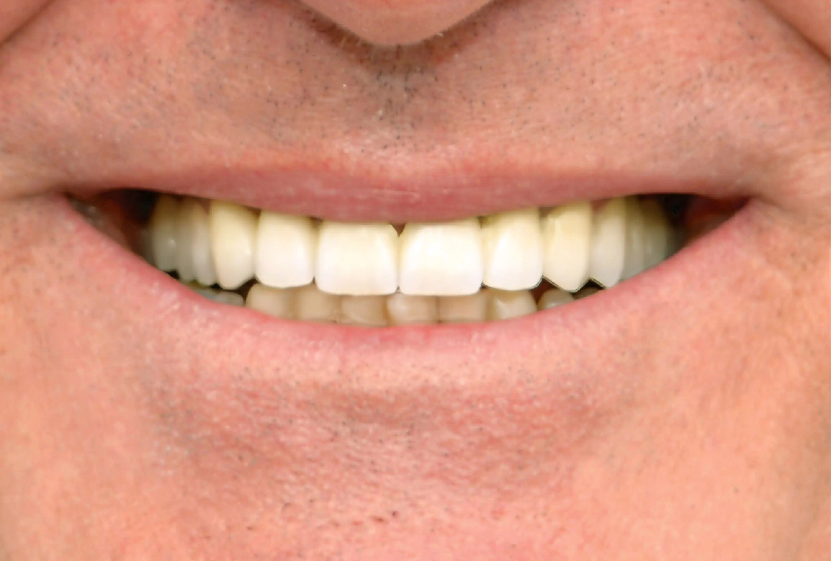Correzione estetica e funzionale:  ponte in ceramica con la base in legura  (sopra e sotto)​ - dopo